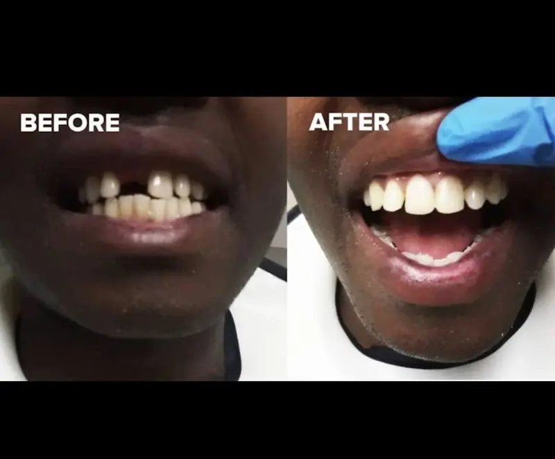 Before and after